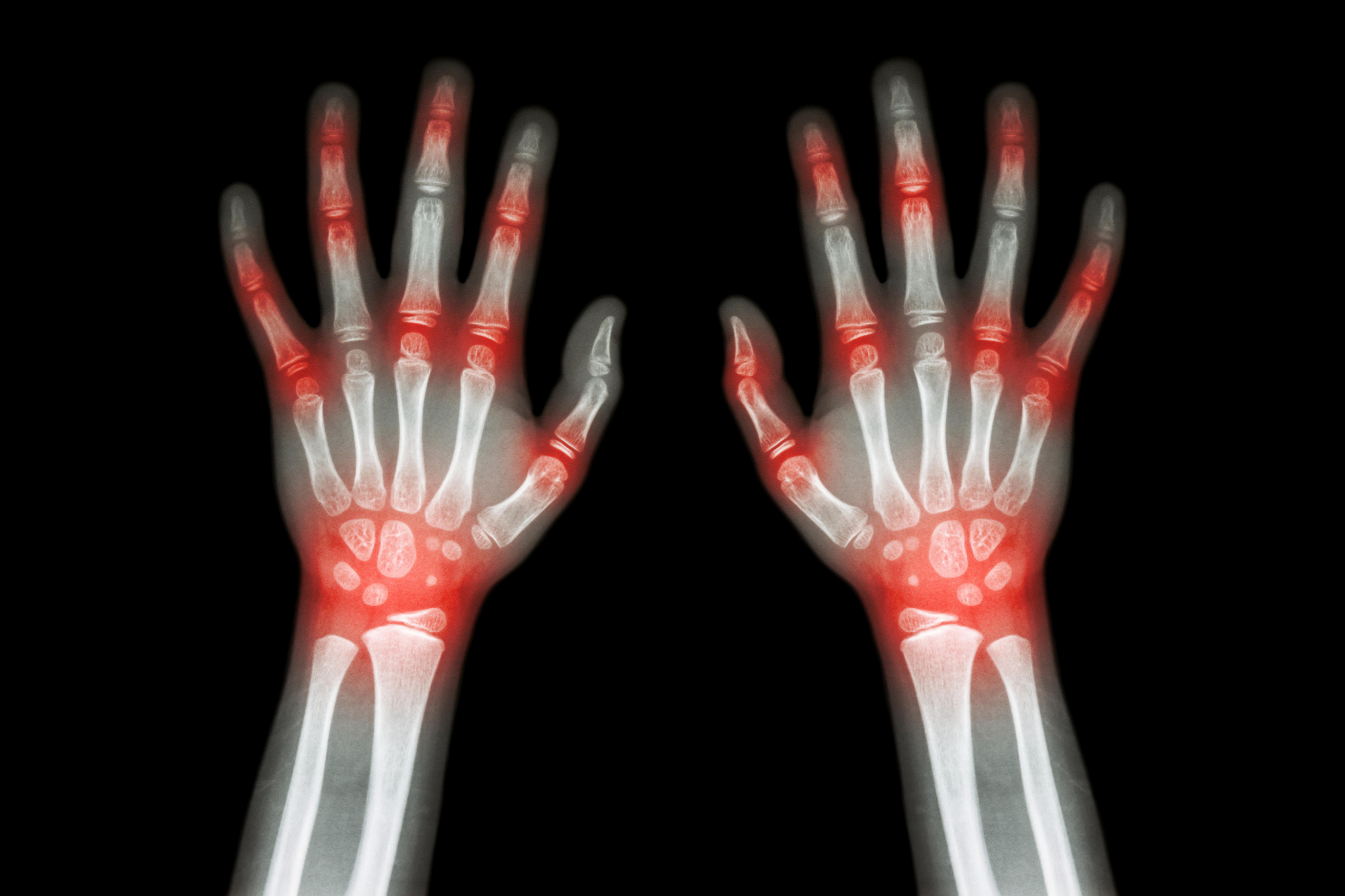 Kronična bolezen revmatoidni artritis